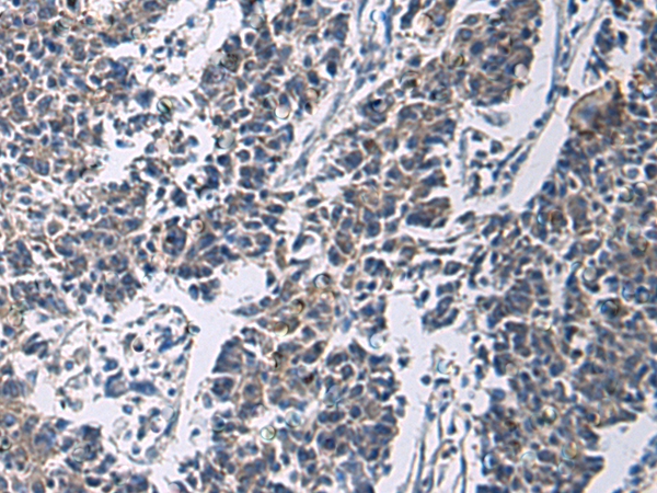 Immunohistochemistry of paraffin-embedded Human colorectal cancer tissue  using SLC30A3 Polyclonal Antibody at dilution of 1:70(×200)