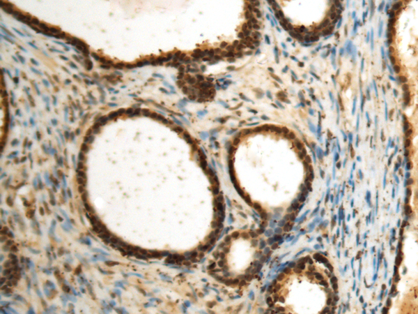 Immunohistochemistry of paraffin-embedded Human prost at e cancer tissue  using SEPHS1 Polyclonal Antibody at dilution of 1:85(×200)