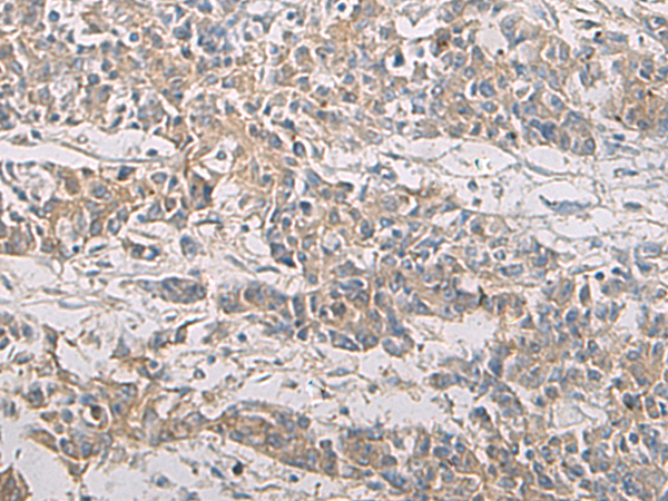 Immunohistochemistry of paraffin-embedded Human colorectal cancer tissue  using PA2G4 Polyclonal Antibody at dilution of 1:60(×200)