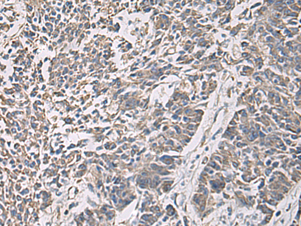 Immunohistochemistry of paraffin-embedded Human colorectal cancer tissue  using PRKCSH Polyclonal Antibody at dilution of 1:90(×200)