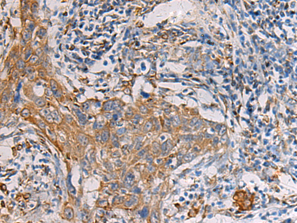 Immunohistochemistry of paraffin-embedded Human esophagus cancer tissue  using PAIP1 Polyclonal Antibody at dilution of 1:60(×200)