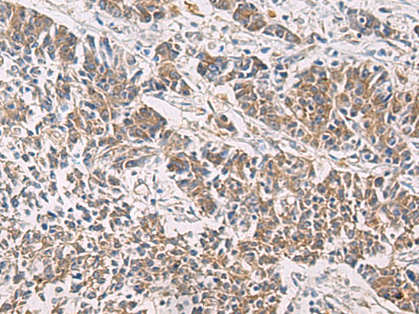 Immunohistochemistry of paraffin-embedded Human colorectal cancer tissue  using PAIP1 Polyclonal Antibody at dilution of 1:60(×200)