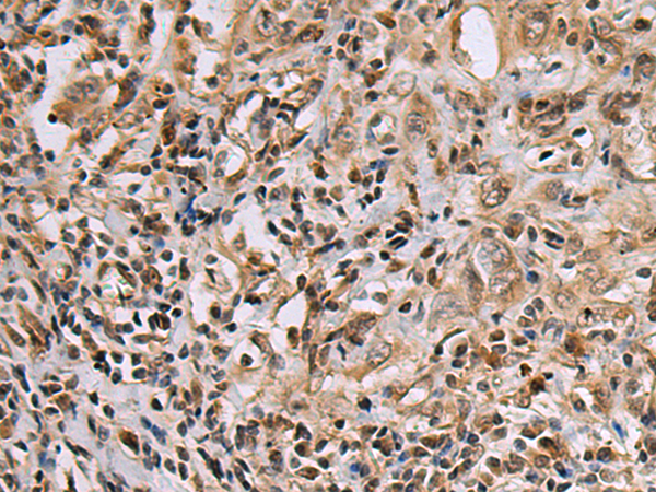 Immunohistochemistry of paraffin-embedded Human esophagus cancer tissue  using DNA2 Polyclonal Antibody at dilution of 1:60(×200)