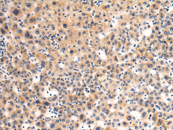 Immunohistochemistry of paraffin-embedded Human liver cancer tissue  using GLT8D1 Polyclonal Antibody at dilution of 1:90(×200)