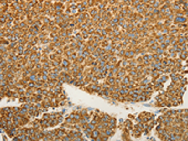 Immunohistochemistry of paraffin-embedded Human liver cancer tissue  using VDAC2 Polyclonal Antibody at dilution of 1:25(×200)