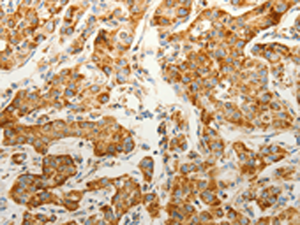 Immunohistochemistry of paraffin-embedded Human lung cancer tissue  using VDAC2 Polyclonal Antibody at dilution of 1:25(×200)