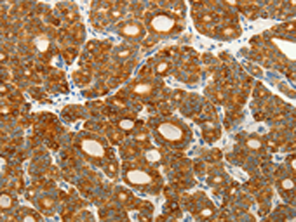 Immunohistochemistry of paraffin-embedded Human thyroid cancer tissue  using VEGFB Polyclonal Antibody at dilution of 1:25(×200)