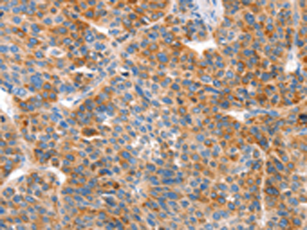 Immunohistochemistry of paraffin-embedded Human liver cancer tissue  using VTN Polyclonal Antibody at dilution of 1:100(×200)