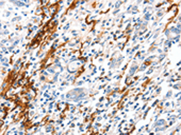 Immunohistochemistry of paraffin-embedded Human gastric cancer tissue  using VTN Polyclonal Antibody at dilution of 1:100(×200)
