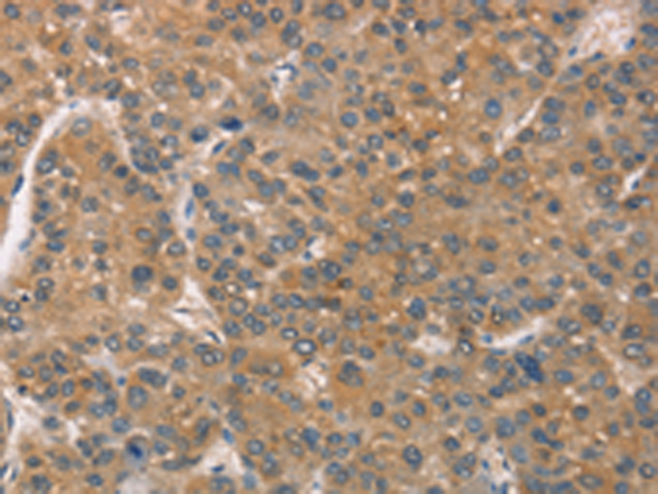 Immunohistochemistry of paraffin-embedded Human liver cancer tissue  using ZADH2 Polyclonal Antibody at dilution of 1:51(×200)