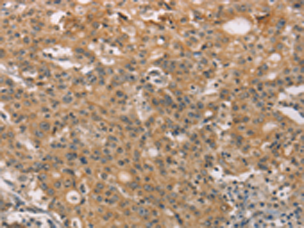 Immunohistochemistry of paraffin-embedded Human gastric cancer tissue  using ZADH2 Polyclonal Antibody at dilution of 1:51(×200)