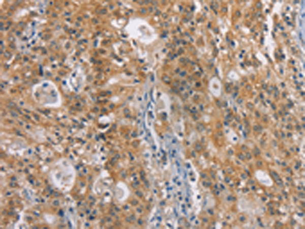 Immunohistochemistry of paraffin-embedded Human gastric cancer tissue  using ZADH2 Polyclonal Antibody at dilution of 1:100(×200)