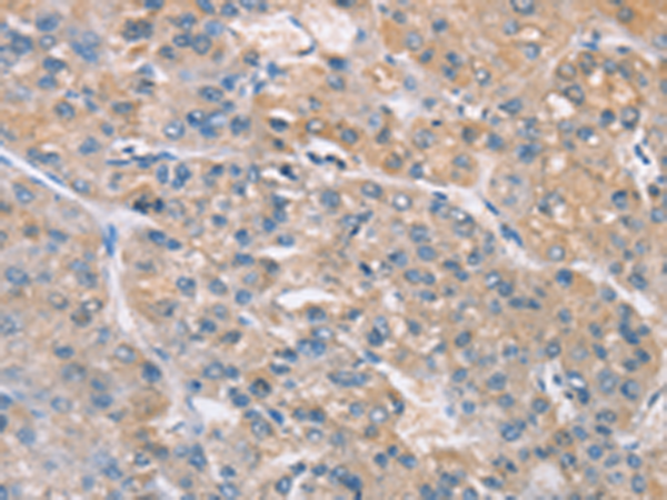 Immunohistochemistry of paraffin-embedded Human liver cancer tissue  using ZADH2 Polyclonal Antibody at dilution of 1:100(×200)