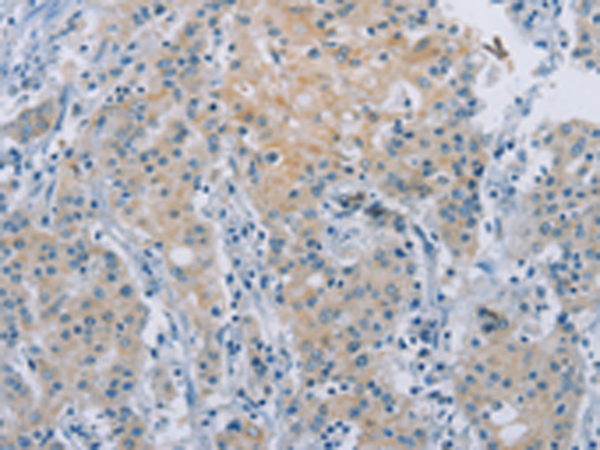 Immunohistochemistry of paraffin-embedded Human gastric cancer tissue  using ZAK  Polyclonal Antibody at dilution of 1:100(×200)