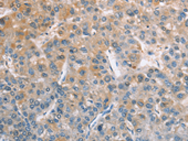 Immunohistochemistry of paraffin-embedded Human liver cancer tissue  using ZAP70  Polyclonal Antibody at dilution of 1:50(×200)