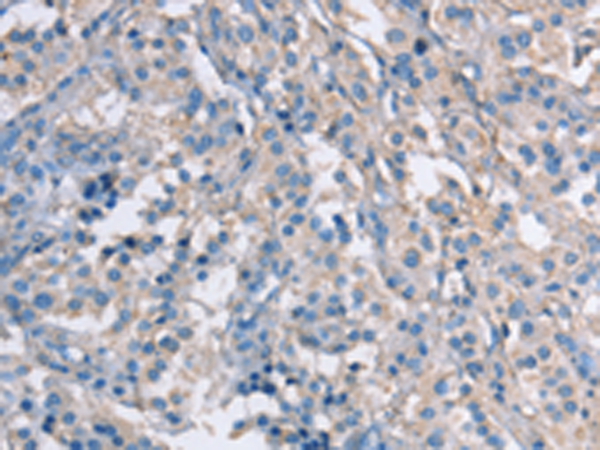 Immunohistochemistry of paraffin-embedded Human thyroid cancer tissue  using ZAP70  Polyclonal Antibody at dilution of 1:50(×200)