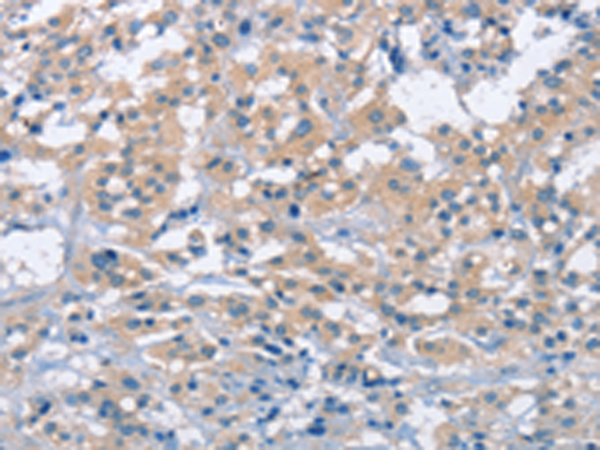 Immunohistochemistry of paraffin-embedded Human thyroid cancer tissue  using ZAP70  Polyclonal Antibody at dilution of 1:50(×200)
