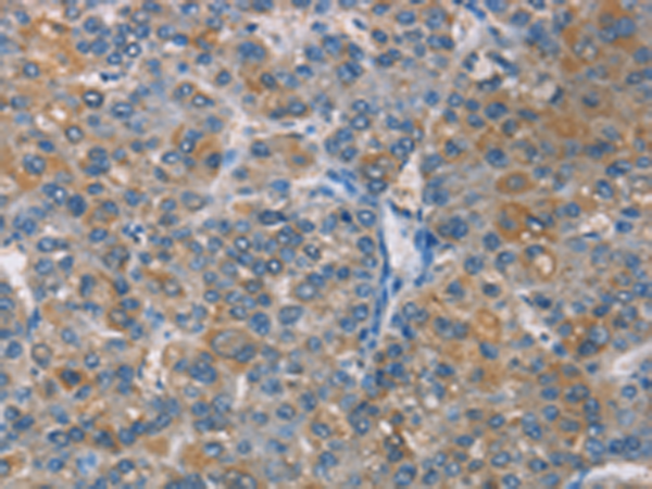 Immunohistochemistry of paraffin-embedded Human liver cancer tissue  using ZBTB1  Polyclonal Antibody at dilution of 1:50(×200)