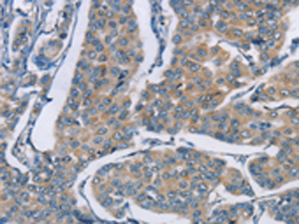 Immunohistochemistry of paraffin-embedded Human breast cancer tissue  using ZBTB1  Polyclonal Antibody at dilution of 1:50(×200)