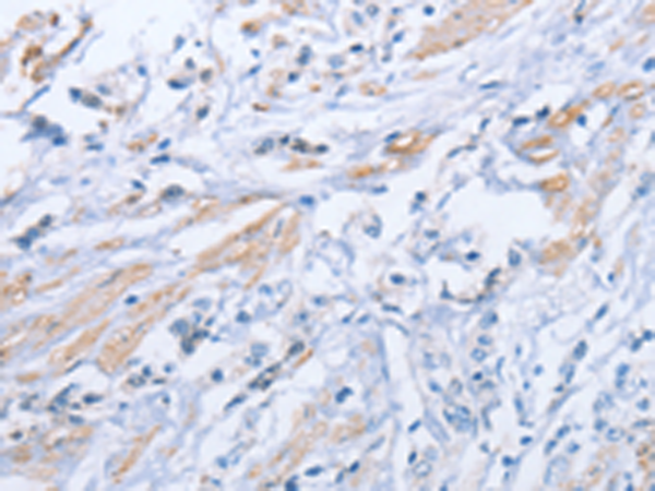 Immunohistochemistry of paraffin-embedded Human prost at e cancer tissue  using ZBTB1  Polyclonal Antibody at dilution of 1:50(×200)