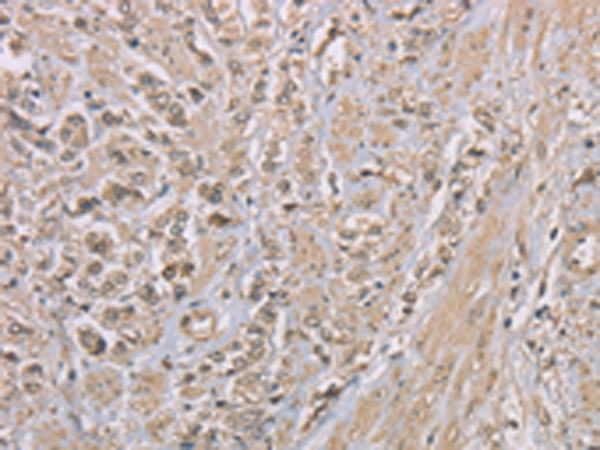 Immunohistochemistry of paraffin-embedded Human prost at e cancer tissue  using ZBTB2  Polyclonal Antibody at dilution of 1:50(×200)