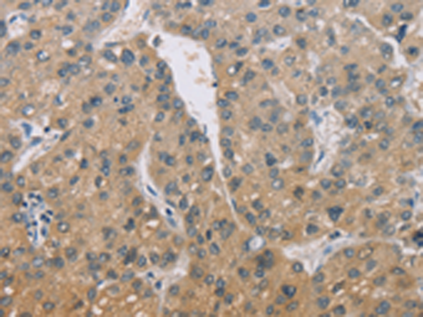 Immunohistochemistry of paraffin-embedded Human liver cancer tissue  using ZBTB6  Polyclonal Antibody at dilution of 1:50(×200)