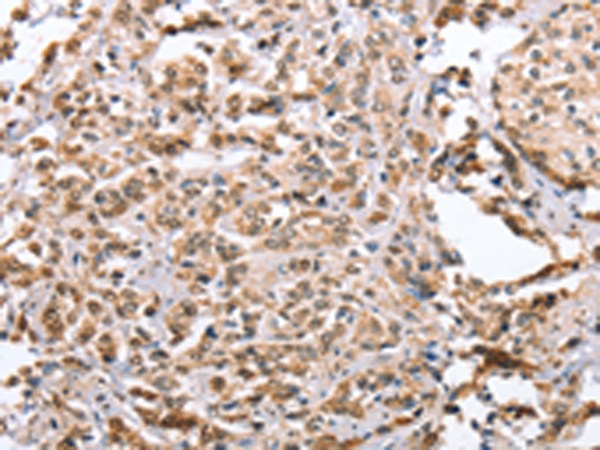 Immunohistochemistry of paraffin-embedded Human prost at e cancer tissue  using ZFYVE16  Polyclonal Antibody at dilution of 1:60(×200)