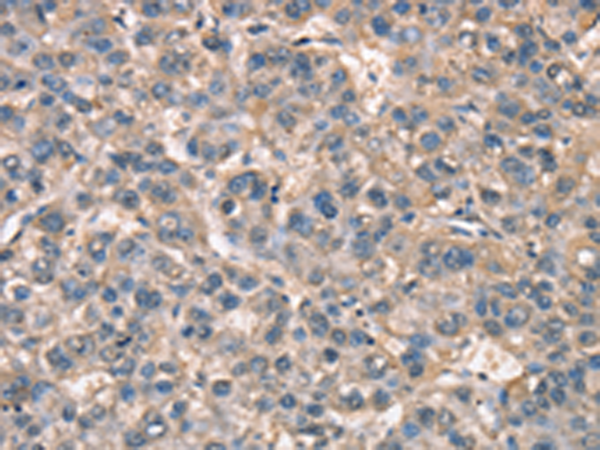 Immunohistochemistry of paraffin-embedded Human liver cancer tissue  using ZFYVE19  Polyclonal Antibody at dilution of 1:60(×200)