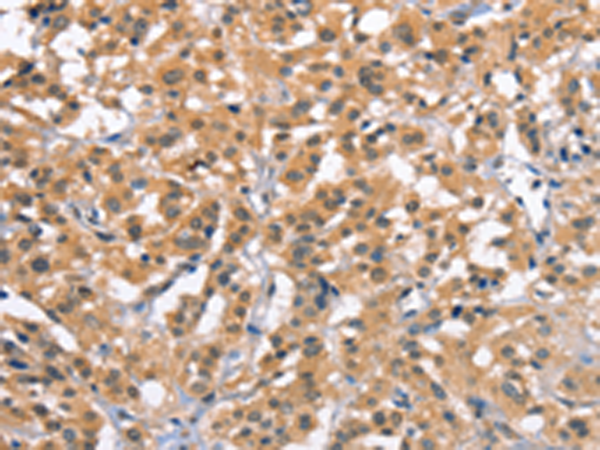 Immunohistochemistry of paraffin-embedded Human thyroid cancer tissue  using ZFYVE19  Polyclonal Antibody at dilution of 1:61(×200)