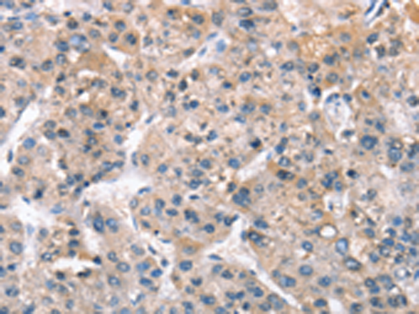 Immunohistochemistry of paraffin-embedded Human liver cancer tissue  using ZFYVE19  Polyclonal Antibody at dilution of 1:61(×200)