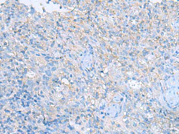 Immunohistochemistry of paraffin-embedded Human tonsil tissue  using HRAS Polyclonal Antibody at dilution of 1:25(×200)