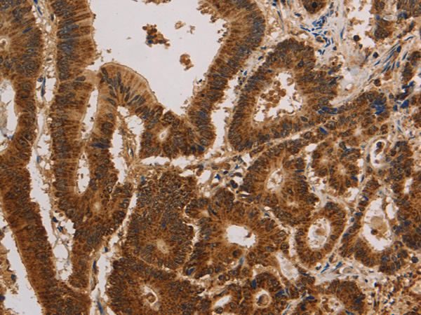 Immunohistochemistry of paraffin-embedded Human colon cancer tissue  using CSNK2B Polyclonal Antibody at dilution of 1:30(×200)