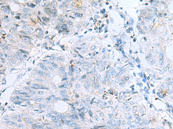 Immunohistochemistry of paraffin-embedded Human colorectal cancer tissue  using POMC Polyclonal Antibody at dilution of 1:35(×200)