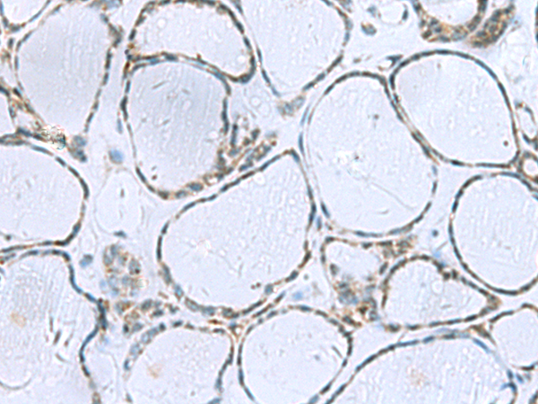 Immunohistochemistry of paraffin-embedded Human thyroid cancer tissue  using POMC Polyclonal Antibody at dilution of 1:35(×200)