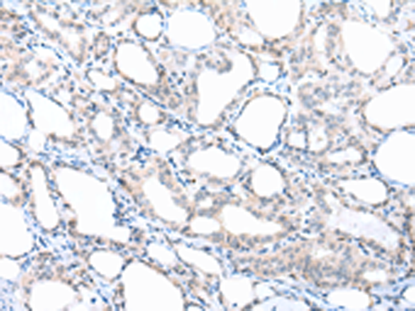 Immunohistochemistry of paraffin-embedded Human thyroid cancer tissue  using PPBP Polyclonal Antibody at dilution of 1:30(×200)