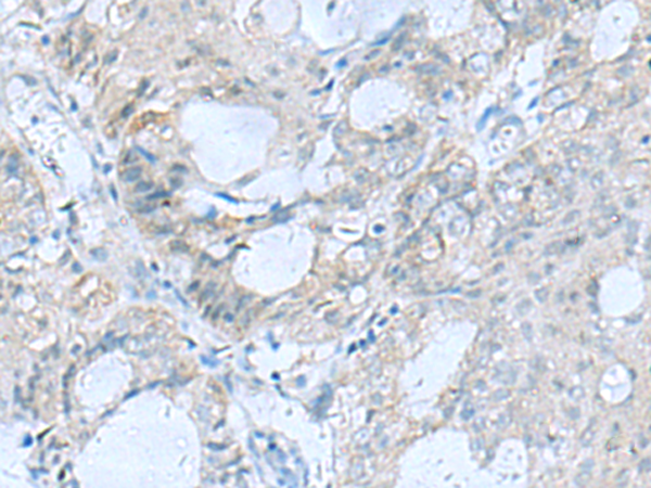 Immunohistochemistry of paraffin-embedded Human ovarian cancer tissue  using GFRA1 Polyclonal Antibody at dilution of 1:65(×200)