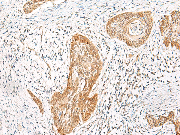 Immunohistochemistry of paraffin-embedded Human esophagus cancer tissue  using HNF1A Polyclonal Antibody at dilution of 1:25(×200)