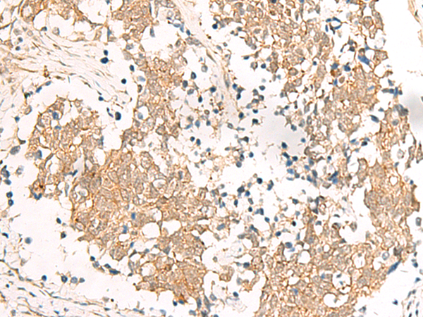 Immunohistochemistry of paraffin-embedded Human lung cancer tissue  using HNF1A Polyclonal Antibody at dilution of 1:25(×200)