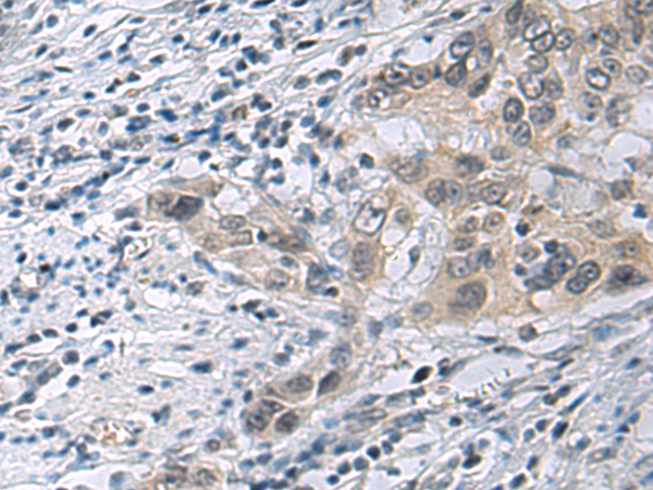 Immunohistochemistry of paraffin-embedded Human esophagus cancer tissue  using IRS4 Polyclonal Antibody at dilution of 1:45(×200)