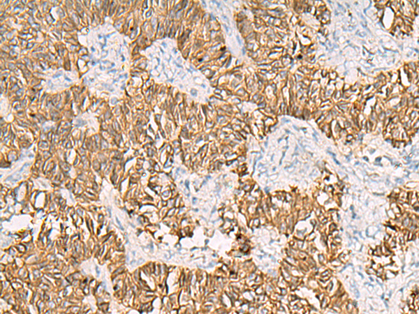 Immunohistochemistry of paraffin-embedded Human ovarian cancer tissue  using SLC16A1 Polyclonal Antibody at dilution of 1:30(×200)