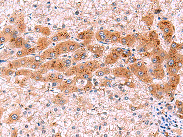 Immunohistochemistry of paraffin-embedded Human liver cancer tissue  using NCAN Polyclonal Antibody at dilution of 1:30(×200)
