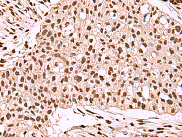 Immunohistochemistry of paraffin-embedded Human esophagus cancer tissue  using SMAD7 Polyclonal Antibody at dilution of 1:40(×200)