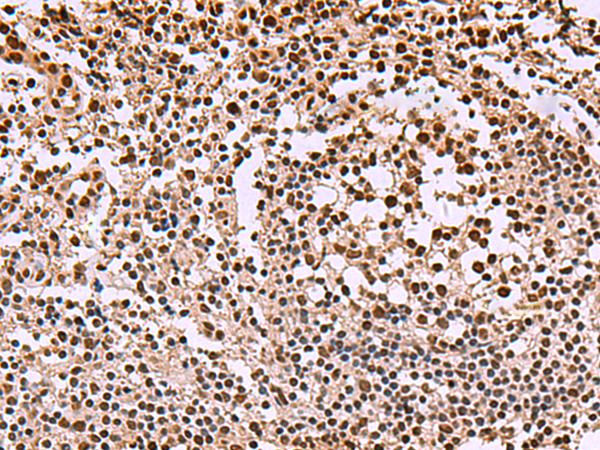 Immunohistochemistry of paraffin-embedded Human tonsil tissue  using SMAD7 Polyclonal Antibody at dilution of 1:40(×200)