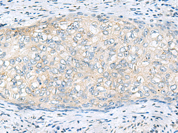 Immunohistochemistry of paraffin-embedded Human cervical cancer tissue  using VEGFA Polyclonal Antibody at dilution of 1:60(×200)