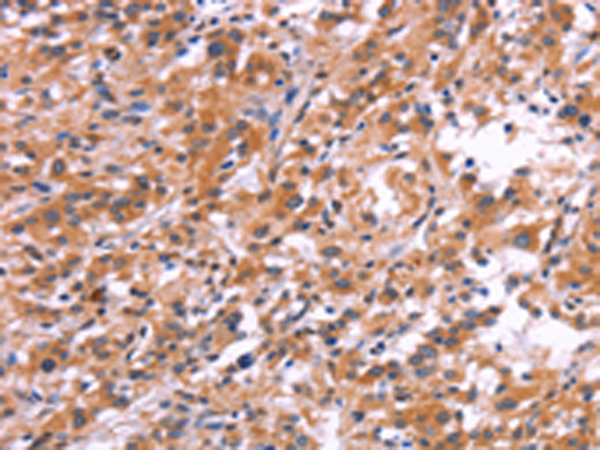 Immunohistochemistry of paraffin-embedded Human thyroid cancer tissue  using APMAP Polyclonal Antibody at dilution of 1:30(×200)