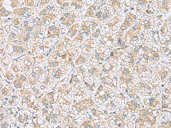 Immunohistochemistry of paraffin-embedded Human liver cancer tissue  using NDRG4 Polyclonal Antibody at dilution of 1:45(×200)