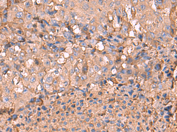 Immunohistochemistry of paraffin-embedded Human liver cancer tissue  using NOTCH4 Polyclonal Antibody at dilution of 1:30(×200)