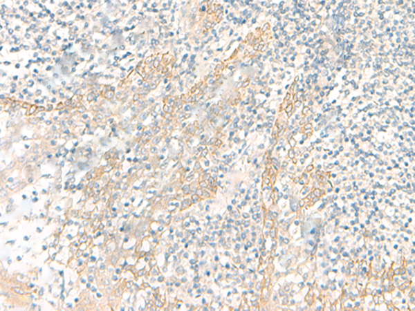 Immunohistochemistry of paraffin-embedded Human tonsil tissue  using PSCA Polyclonal Antibody at dilution of 1:25(×200)