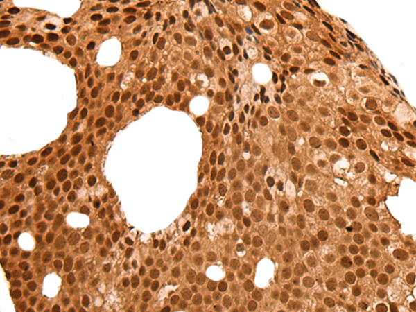 Immunohistochemistry of paraffin-embedded Human breast cancer tissue  using NEK7 Polyclonal Antibody at dilution of 1:60(×200)