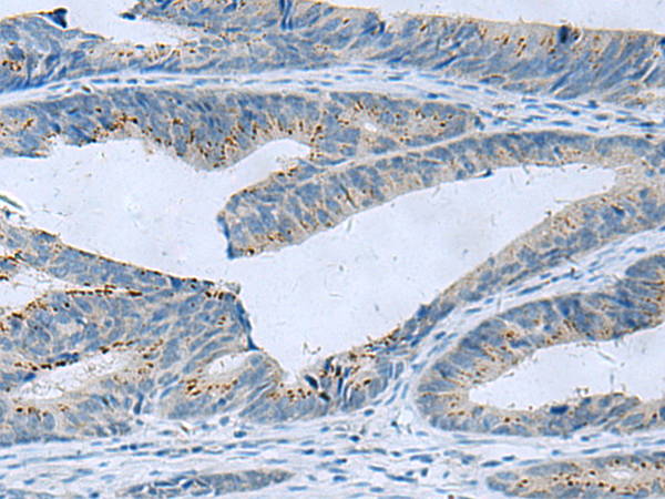 Immunohistochemistry of paraffin-embedded Human colorectal cancer tissue  using GLS Polyclonal Antibody at dilution of 1:60(×200)